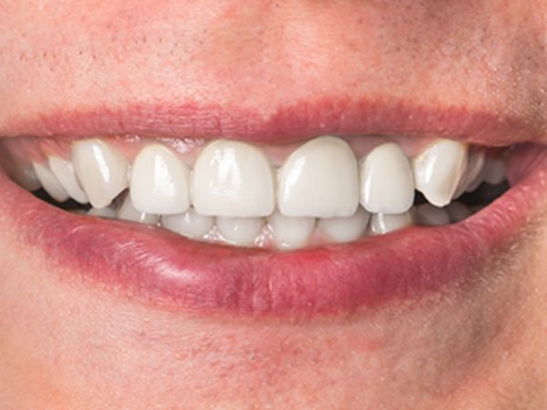 After root canal treatment