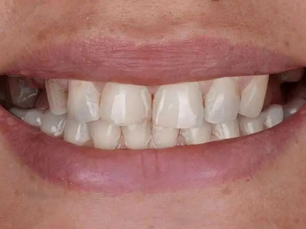 Before dental implants treatment